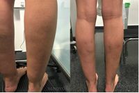 lipedemajovenpostagua